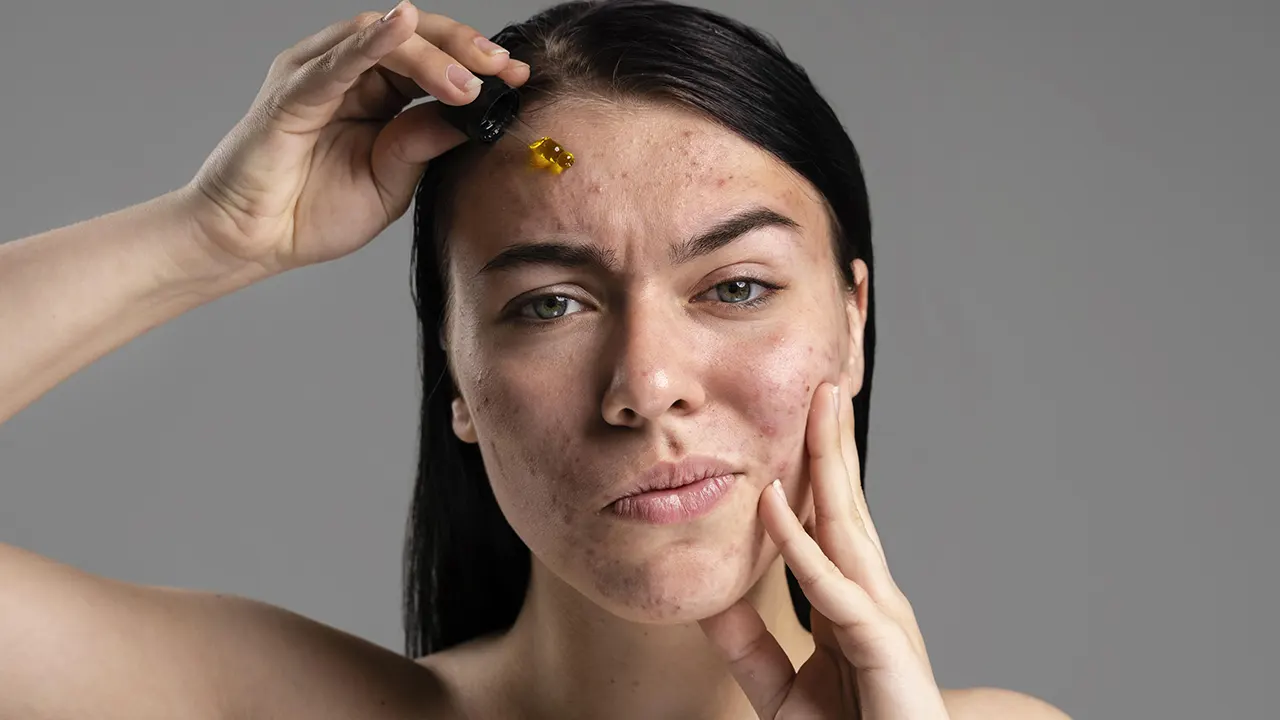 acne-adulta-depois-dos-30-como-prevenir-e-cuidar